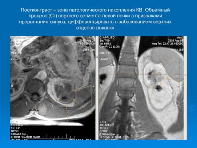 Постконтраст – зона патологического накопления КВ. Объемный процесс (Cr) верхнего