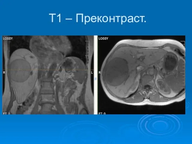 Т1 – Преконтраст.