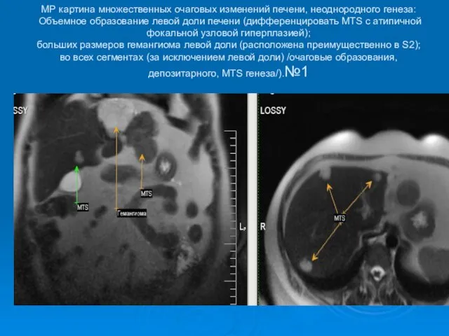 МР картина множественных очаговых изменений печени, неоднородного генеза: Объемное образование