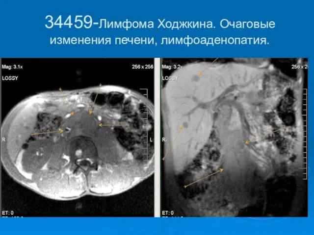 34459-Лимфома Ходжкина. Очаговые изменения печени, лимфоаденопатия.