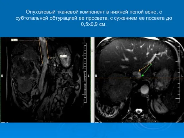 Опухолевый тканевой компонент в нижней полой вене, с субтотальной обтурацией