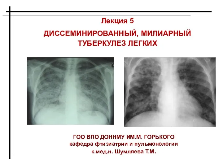 Диссеминированный, милиарный туберкулез легких. Лекция 5