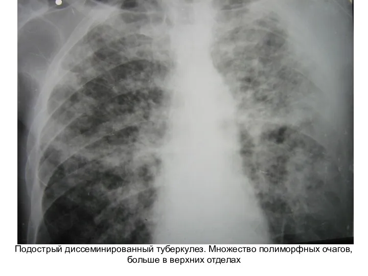 Подострый диссеминированный туберкулез. Множество полиморфных очагов, больше в верхних отделах
