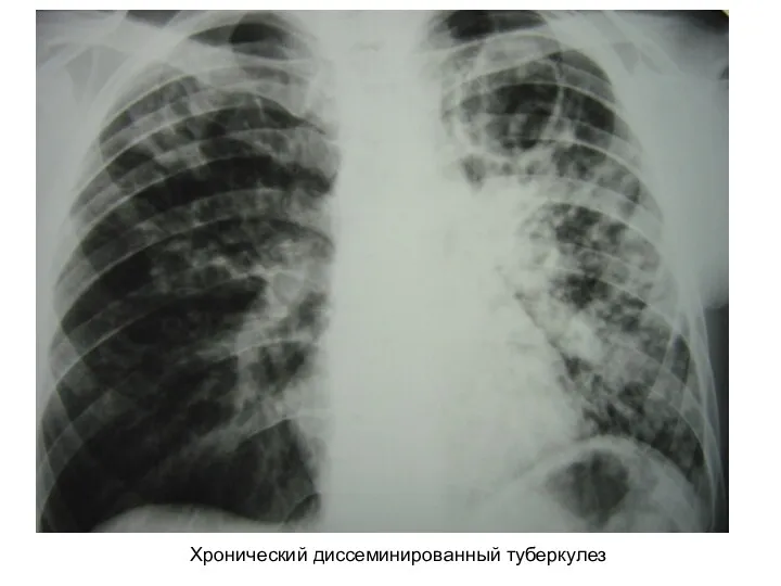 Хронический диссеминированный туберкулез