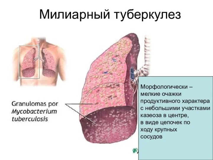 Милиарный туберкулез Милиарный туберкулез – гематогенная, почти всегда генерализованная форма