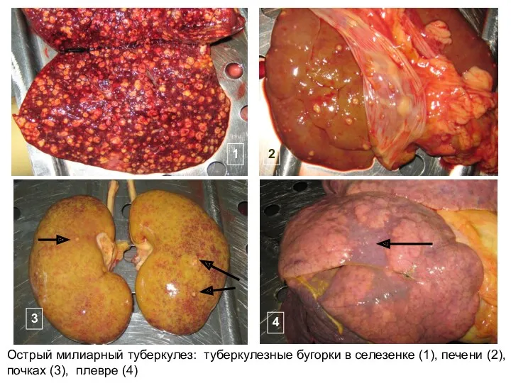 Острый милиарный туберкулез: туберкулезные бугорки в селезенке (1), печени (2),