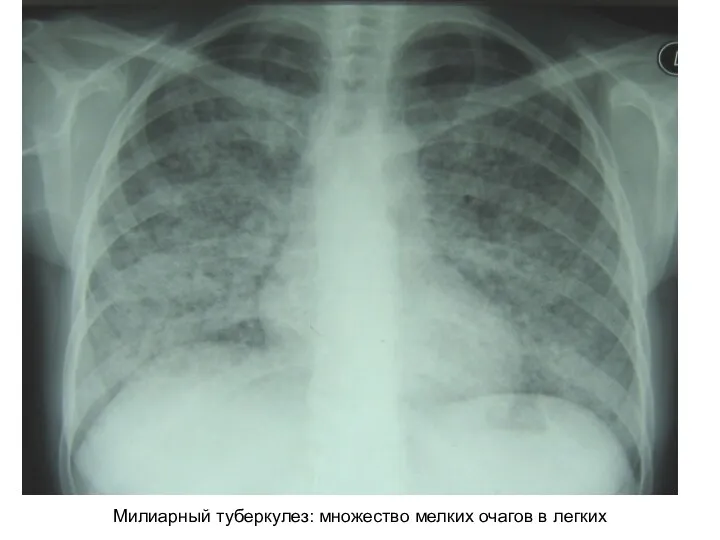 Милиарный туберкулез: множество мелких очагов в легких