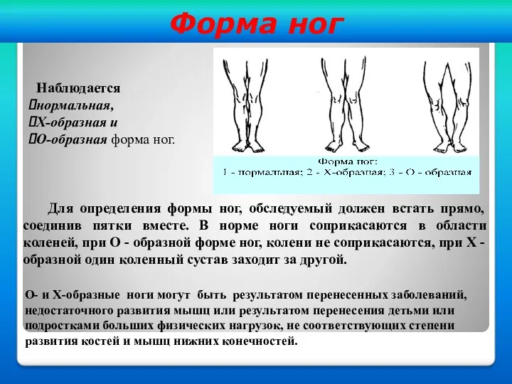 Форма ног О- и Х-образные ноги могут быть результатом перенесенных заболеваний, недостаточного развития