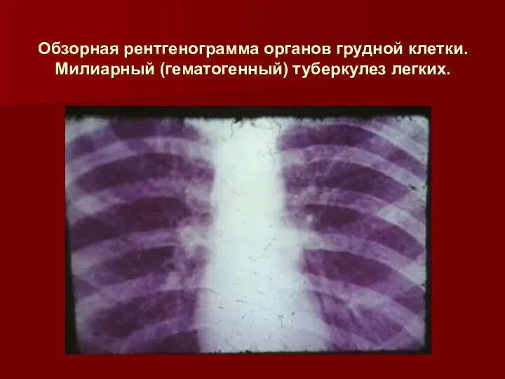 Обзорная рентгенограмма органов грудной клетки. Милиарный (гематогенный) туберкулез легких.