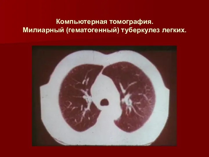 Компьютерная томография. Милиарный (гематогенный) туберкулез легких.