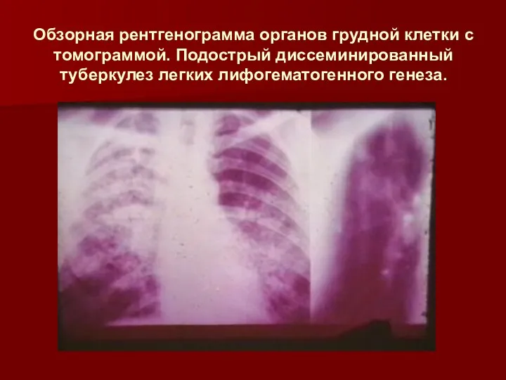 Обзорная рентгенограмма органов грудной клетки с томограммой. Подострый диссеминированный туберкулез легких лифогематогенного генеза.