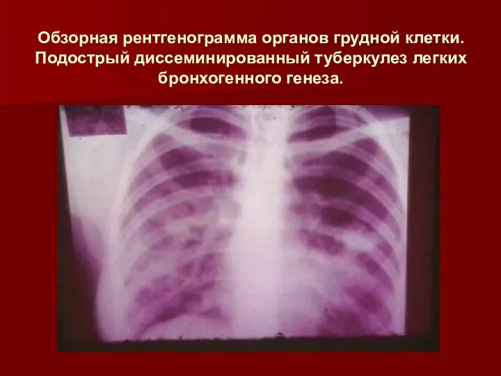 Обзорная рентгенограмма органов грудной клетки. Подострый диссеминированный туберкулез легких бронхогенного генеза.