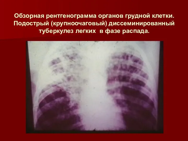 Обзорная рентгенограмма органов грудной клетки. Подострый (крупноочаговый) диссеминированный туберкулез легких в фазе распада.