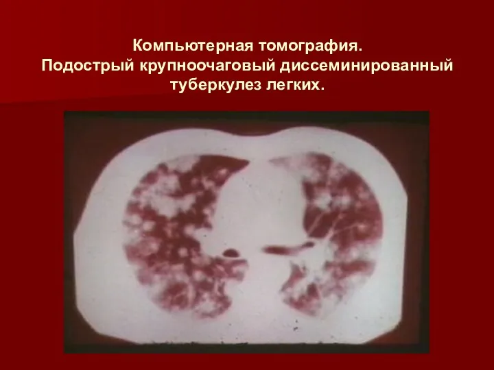 Компьютерная томография. Подострый крупноочаговый диссеминированный туберкулез легких.