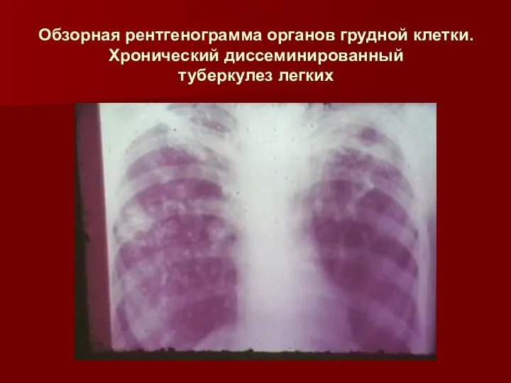 Обзорная рентгенограмма органов грудной клетки. Хронический диссеминированный туберкулез легких