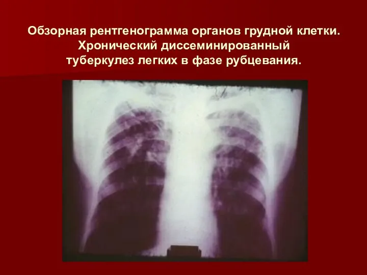 Обзорная рентгенограмма органов грудной клетки. Хронический диссеминированный туберкулез легких в фазе рубцевания.