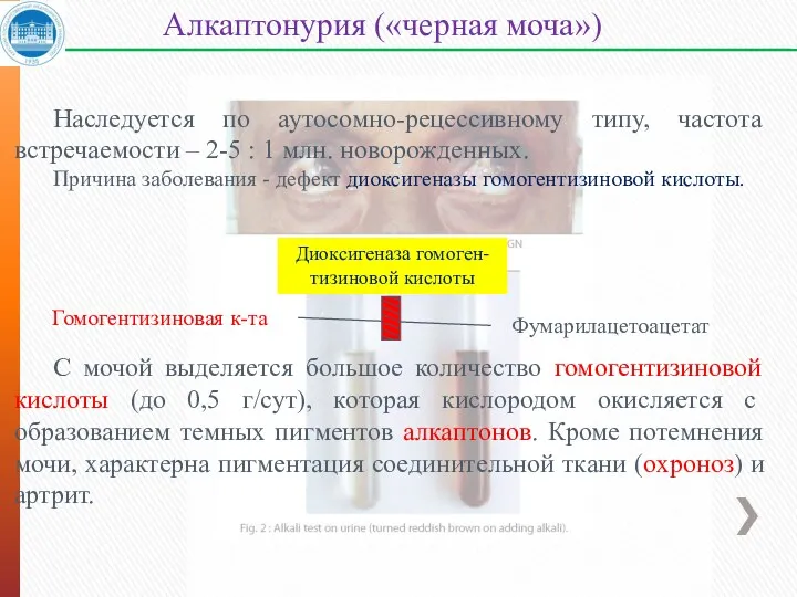 Наследуется по аутосомно-рецессивному типу, частота встречаемости – 2-5 : 1