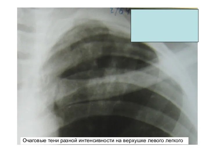 Очаговые тени разной интенсивности на верхушке левого легкого