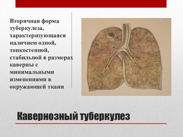 Кавернозный туберкулез Вторичная форма туберкулеза, характеризующаяся наличием одной, тонкостенной, стабильной