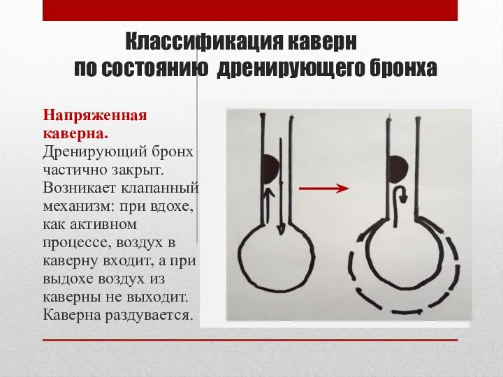 Классификация каверн по состоянию дренирующего бронха Напряженная каверна. Дренирующий бронх