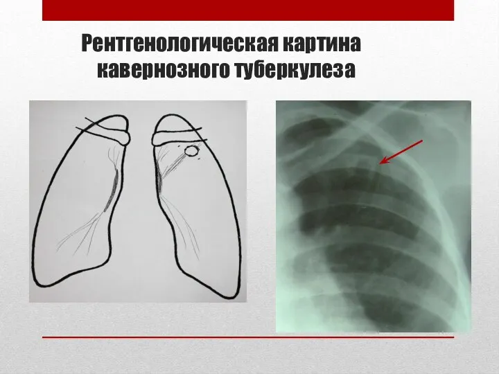Рентгенологическая картина кавернозного туберкулеза