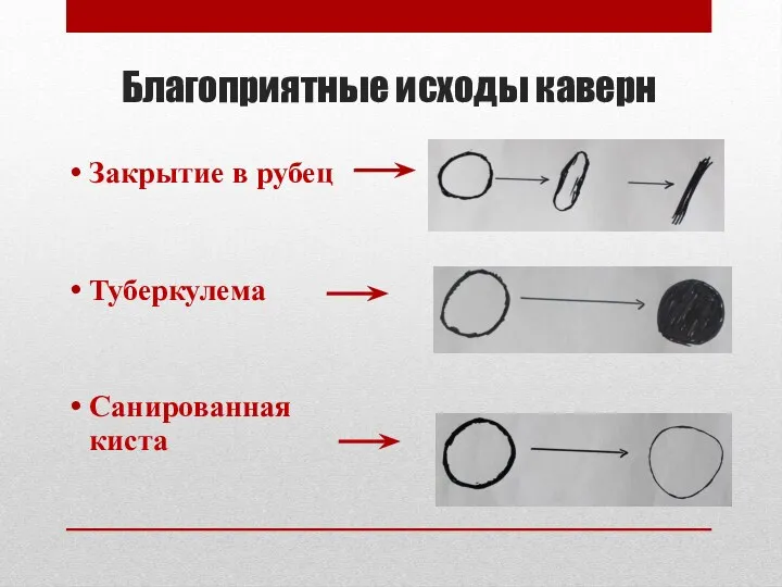 Благоприятные исходы каверн Закрытие в рубец Туберкулема Санированная киста