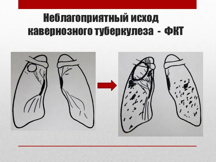 Неблагоприятный исход кавернозного туберкулеза - ФКТ