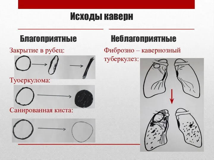 Исходы каверн Благоприятные Закрытие в рубец: Туберкулома: Санированная киста: Неблагоприятные Фиброзно – кавернозный туберкулез: