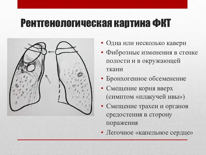 Рентгенологическая картина ФКТ Одна или несколько каверн Фиброзные изменения в