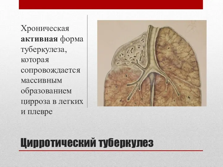 Цирротический туберкулез Хроническая активная форма туберкулеза, которая сопровождается массивным образованием цирроза в легких и плевре