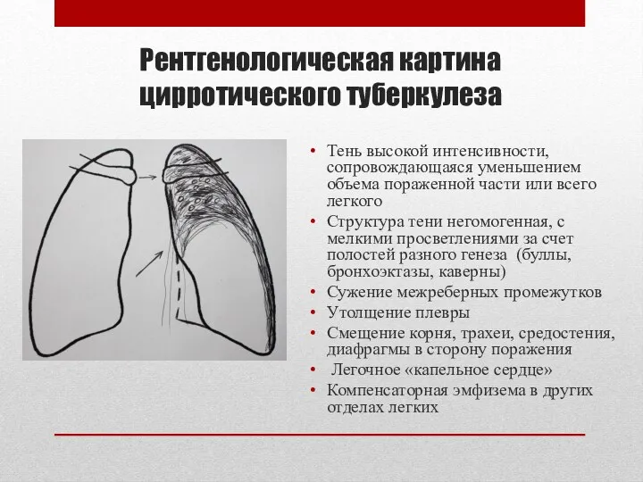 Рентгенологическая картина цирротического туберкулеза Тень высокой интенсивности, сопровождающаяся уменьшением объема