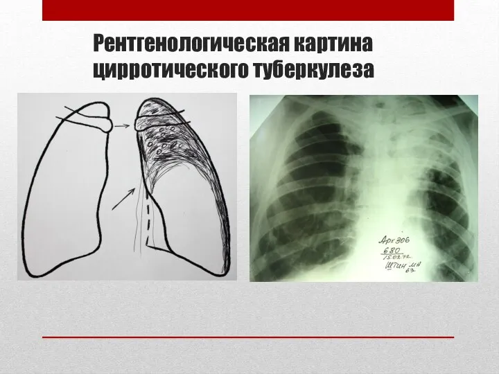 Рентгенологическая картина цирротического туберкулеза