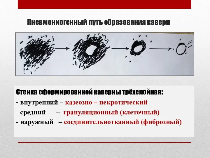 Пневмониогенный путь образования каверн Стенка сформированной каверны трёхслойная: - внутренний