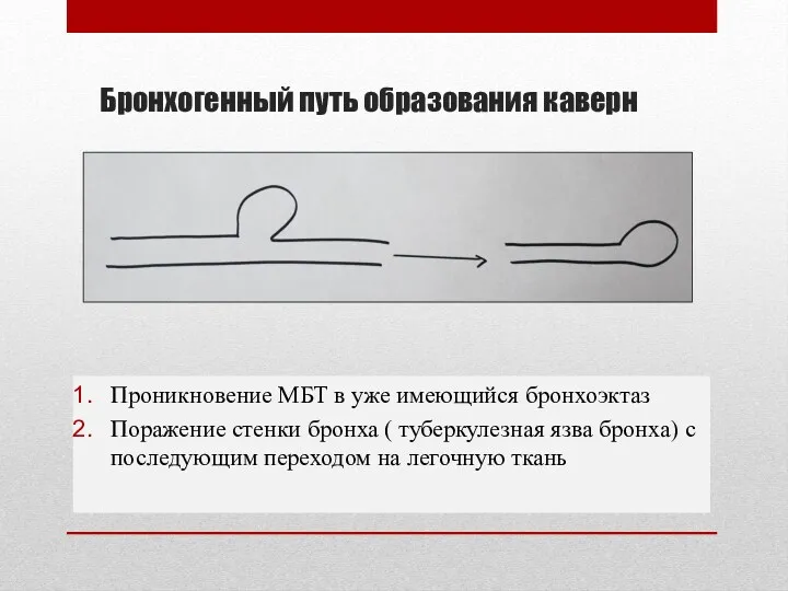 Бронхогенный путь образования каверн Проникновение МБТ в уже имеющийся бронхоэктаз