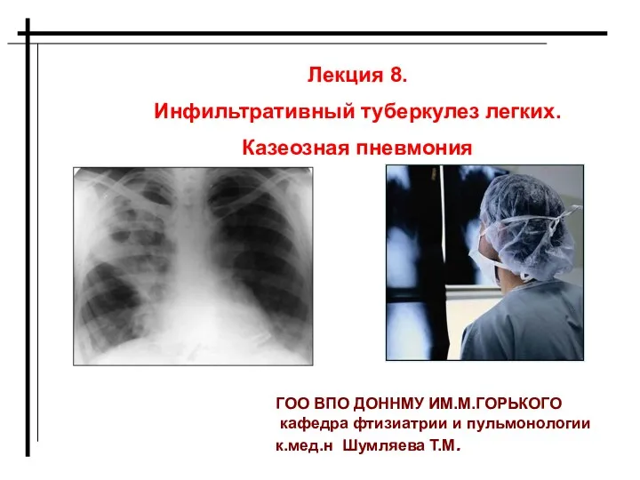 Инфильтративный туберкулез легких. Казеозная пневмония. Лекция 8