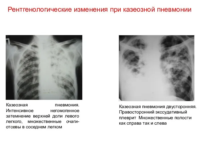 Рентгенологические изменения при казеозной пневмонии Казеозная пневмония двусторонняя. Правосторонний экссудативный