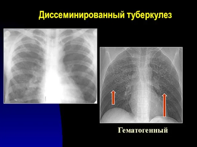 Диссеминированный туберкулез Гематогенный
