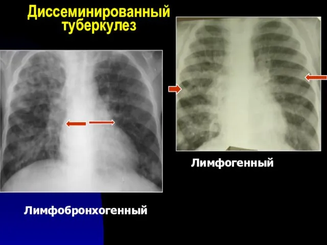 Диссеминированный туберкулез Лимфобронхогенный Лимфогенный