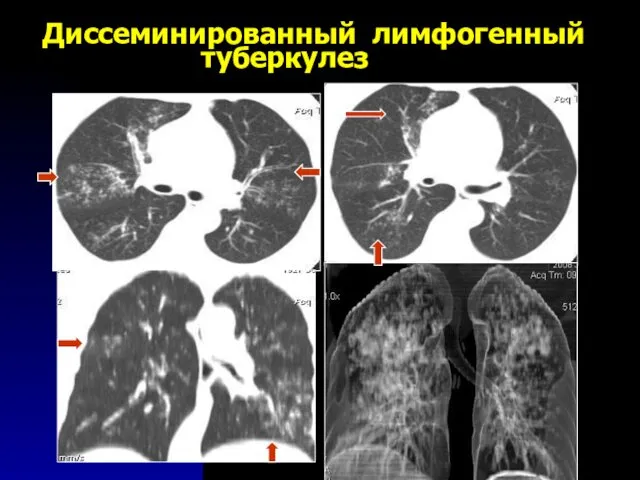 Диссеминированный лимфогенный туберкулез