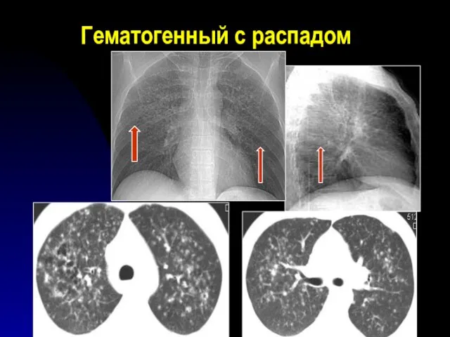 Гематогенный с распадом