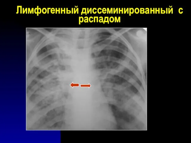 Лимфогенный диссеминированный с распадом