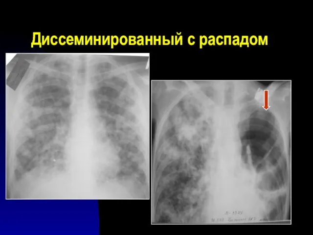 Диссеминированный с распадом