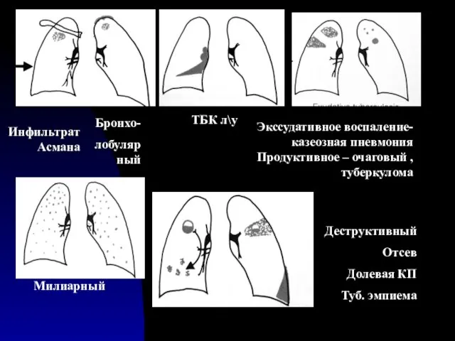 Инфильтрат Асмана Бронхо- лобулярный Милиарный Экссудативное воспаление- казеозная пневмония Продуктивное