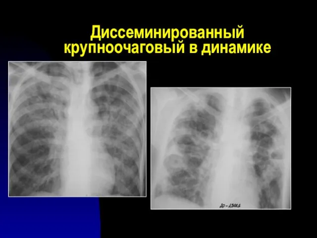 Диссеминированный крупноочаговый в динамике