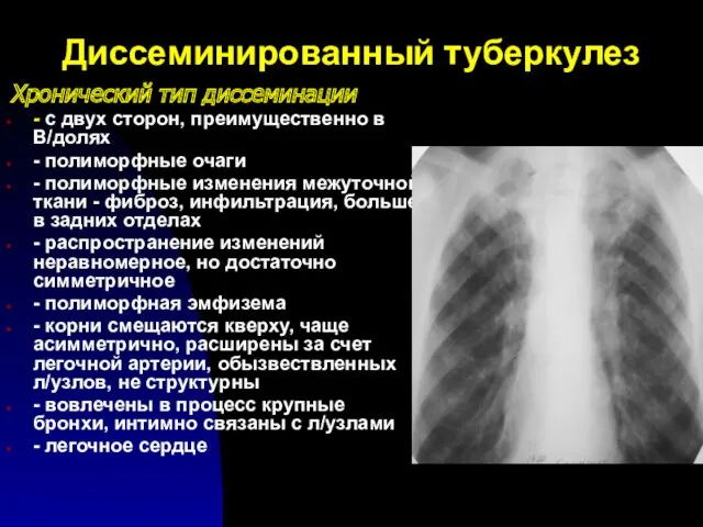 Диссеминированный туберкулез Хронический тип диссеминации - с двух сторон, преимущественно