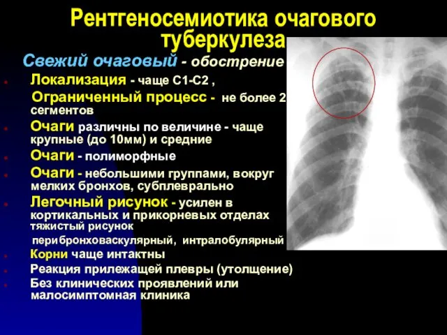 Рентгеносемиотика очагового туберкулеза Свежий очаговый - обострение Локализация - чаще