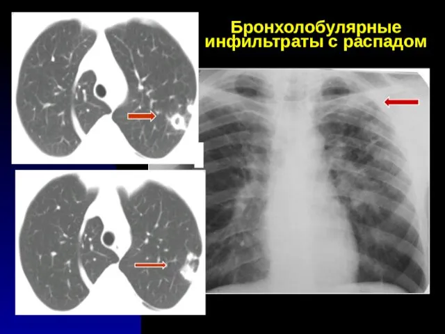 Бронхолобулярные инфильтраты с распадом