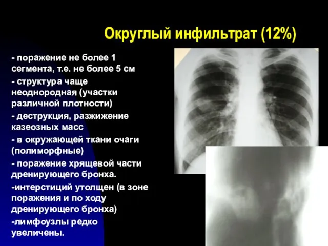 Округлый инфильтрат (12%) - поражение не более 1 сегмента, т.е.