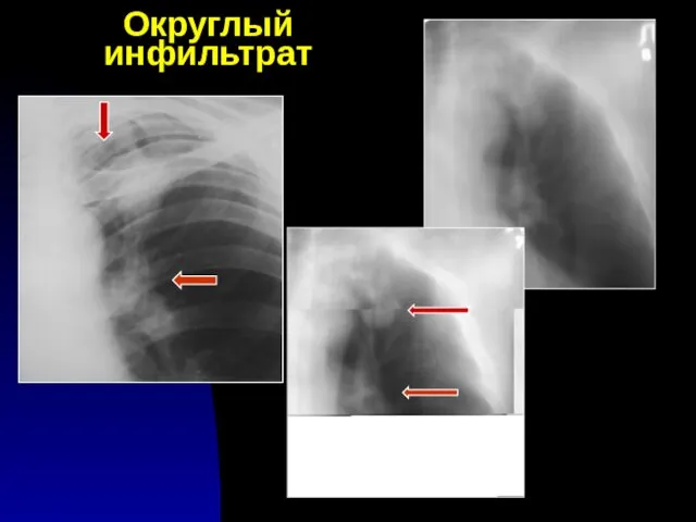 Округлый инфильтрат