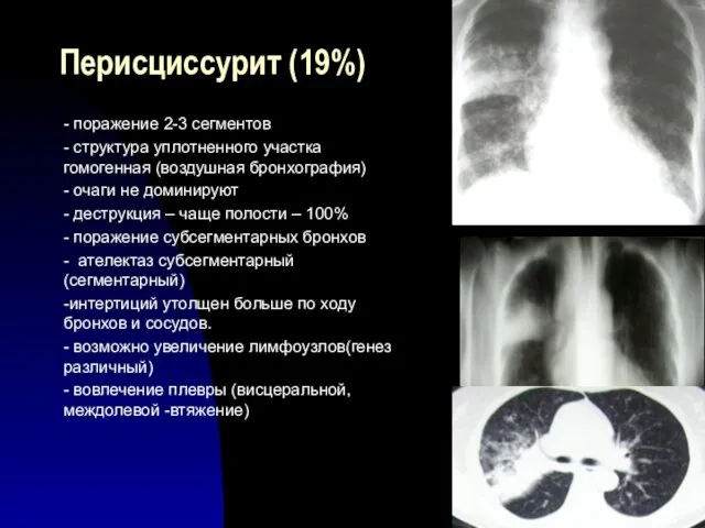 Перисциссурит (19%) - поражение 2-3 сегментов - структура уплотненного участка гомогенная (воздушная бронхография)